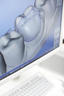 Keine Chance für Amalgam: hochwertige Zahnversorgung mit Komposit-Füllungen smilni_Zahninlays Keine Chance für Amalgam: hochwertige Zahnversorgung mit Komposit-Füllungen